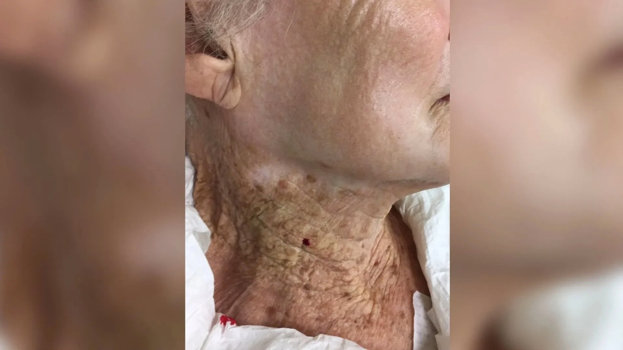 Idosa passa 40 anos usando filtro solar só no rosto e diferença é chocante