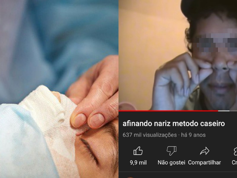 Rinoplastia caseira: Vídeos de como afinar nariz deixam homem internado e preocupam médicos