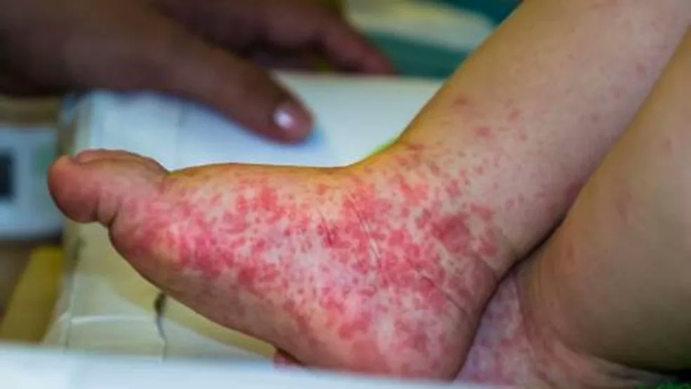 Gripe do Tomate: Surto tem quase 100 crianças infectadas na Índia