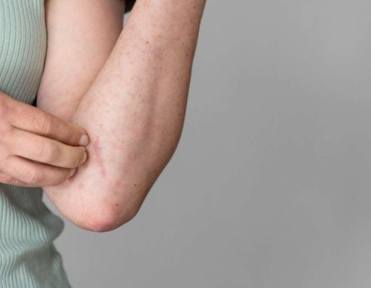 Febre Oropouche é tema de oficina do Ministério da Saúde em Manaus