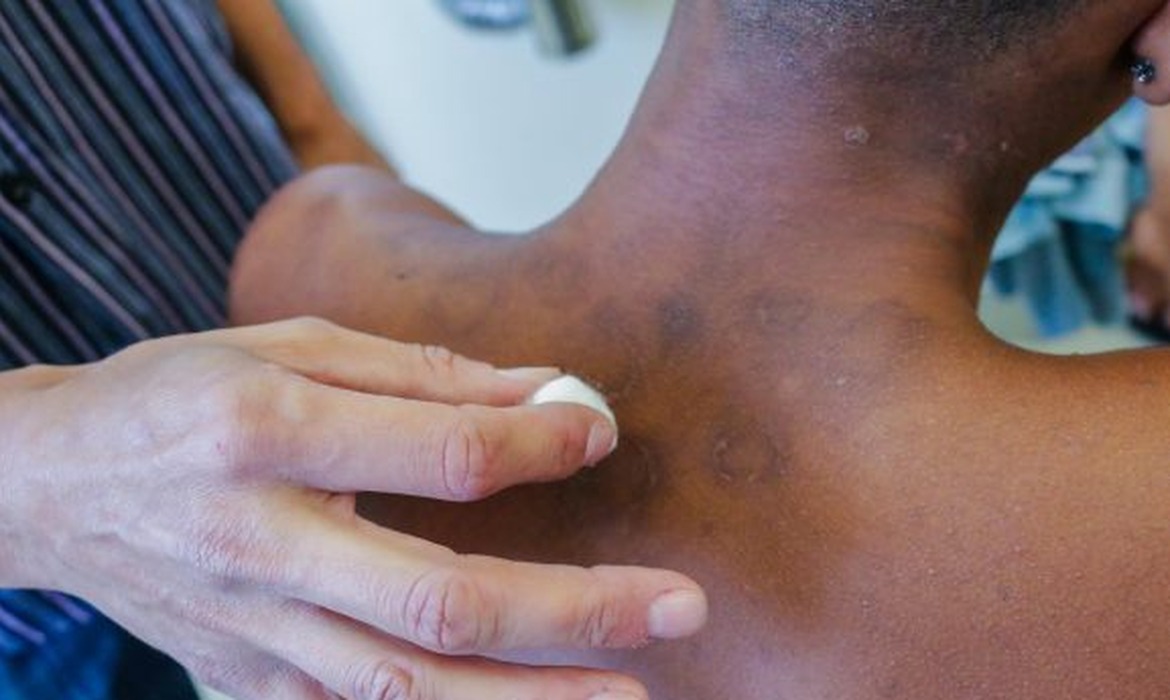 Ações para detectar novos casos de hanseníase são intensificadas em Manaus