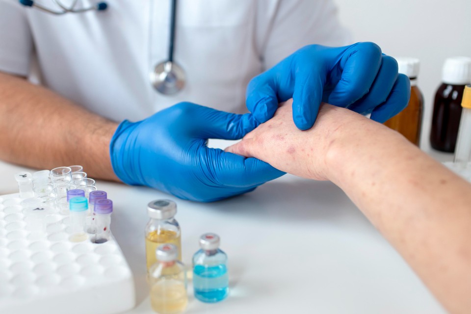 OMS avalia se mpox deve voltar a ser declarada emergência global
