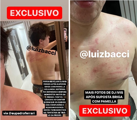 Imagens mostram DJ Ivis machucado após suposta briga com Pamella Holanda