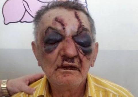 Idoso de 74 anos leva 40 pontos no rosto depois de ser espancado