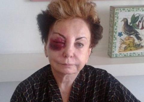  Beatriz Segall quer processar prefeitura do Rio após tombo em calçada esburacada