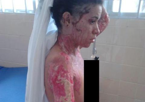 Em briga amorosa por causa de motorista de ônibus, Simone foi atingida com ácido