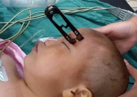 Menino sobrevive milagrosamente depois de cair sobre tesoura e perfurar a cabeça