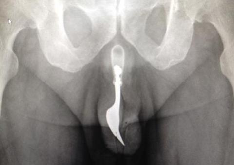  Idoso de 70 anos enfia garfo em órgão genital e é levado para hospital