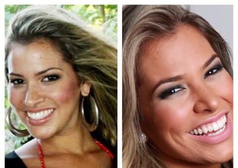  Ex-BBB Adriana mostra nariz antes e depois da cirurgia 