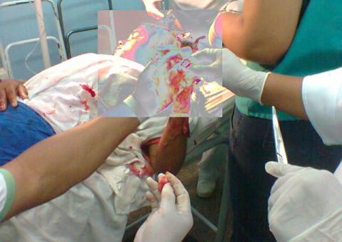 Ao resistir a estupro garota é ferida com vários golpes de terçado na cabeça 