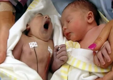 Bebê de 100 minutos tornou-se o mais jovem doador de rins