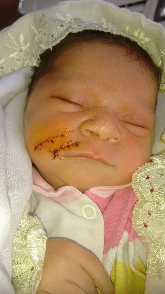 Cesárea deixa rosto de bebê cortado após parto de emergência