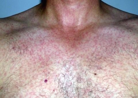 Fiocruz alerta sobre   epidemias de Chikungunya   e Zika 