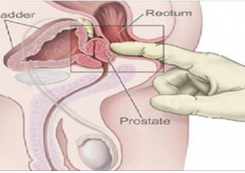 2 superdicas para prevenir e tratar doenças da próstata de forma 100% natural