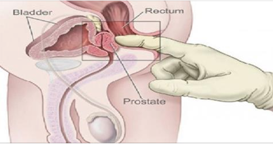 2 superdicas para prevenir e tratar doenças da próstata de forma 100% natural