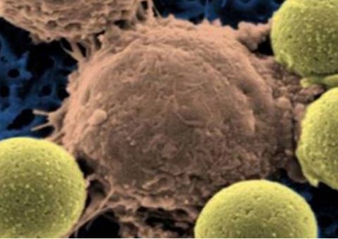 Novo e arriscado tratamento tem remissão em 82% de pacientes com leucemia