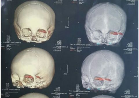 Após queda bebê de um ano fica com caneta cravada no olho 