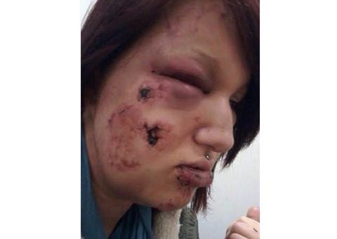 Mulher tem rosto ‘mastigado' por ex-namorado inconformado com separação 