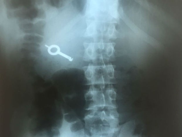 Raio X mostra chave engolida por detento durante rebelião