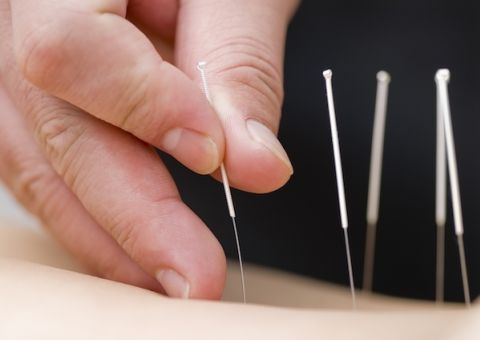 Conheça os benefícios da acupuntura para a saúde