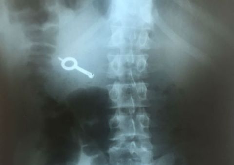 Raio-X mostra chave engolida por preso durante rebelião no Paraná