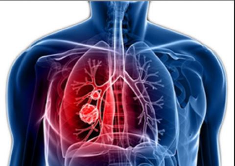 Chega ao Brasil novo medicamento contra câncer de pulmão