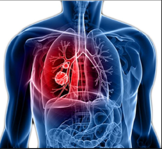 Chega ao Brasil novo medicamento contra câncer de pulmão