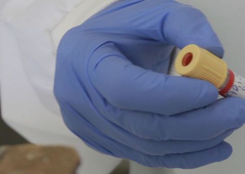 Vírus misterioso deixa a urina preta em Salvador