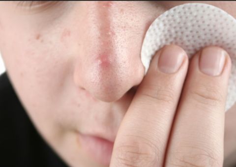 Compressa com chá de Japecanga pode eliminar acnes