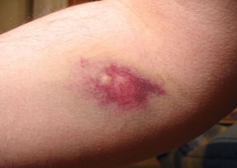 Por que ficamos com hematomas?