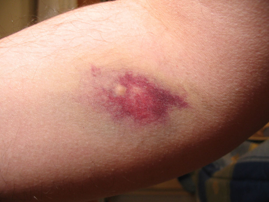 Por que ficamos com hematomas?
