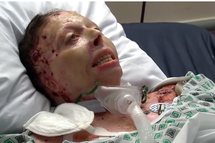 Homem ateia fogo em namorada após discussão 