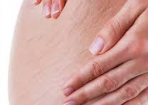 Saiba como eliminar manchas e estrias de forma natural