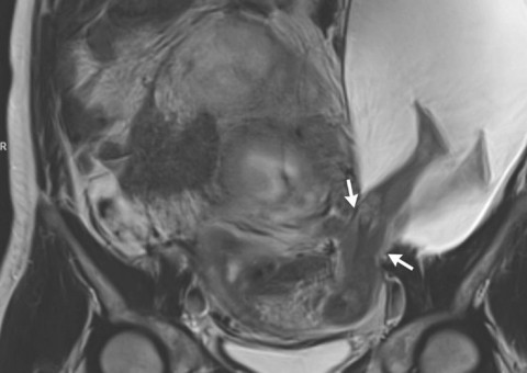 Gestante surpreende médicos com caso raríssimo