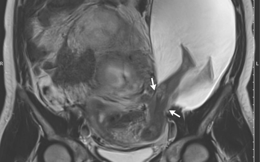 Gestante surpreende médicos com caso raríssimo