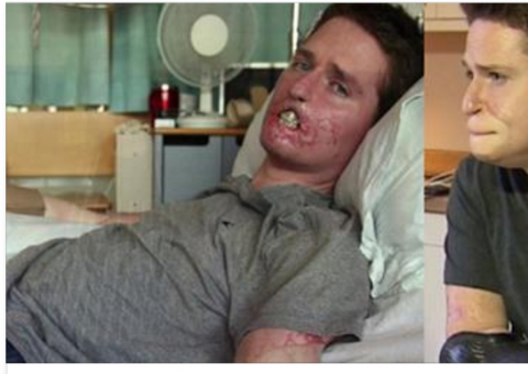 Homem que perdeu todos os membros após infecção, volta a trabalhar