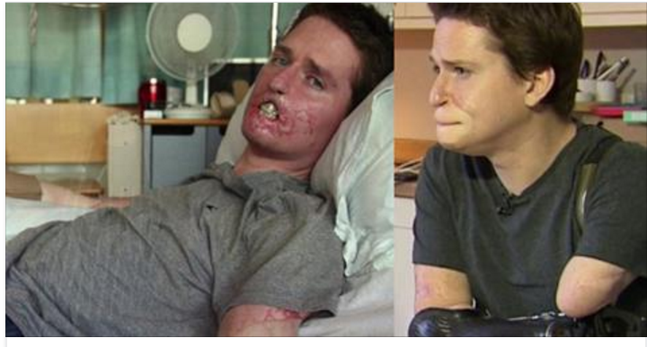 Homem que perdeu todos os membros após infecção, volta a trabalhar