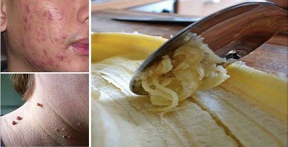 Conheça os benefícios da casca da banana e se surpreenda