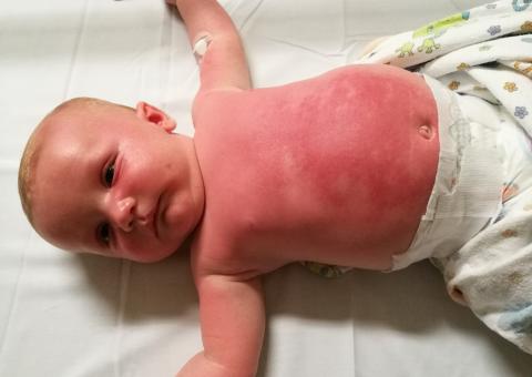 Bebê de 3 meses passa mal após usar filtro solar da Peppa Pig  