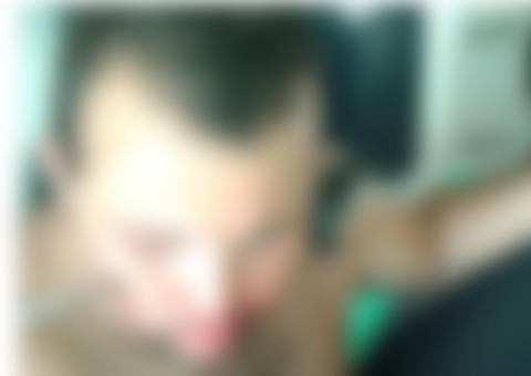 Lança de pescar dispara e fica presa em rosto de homem 