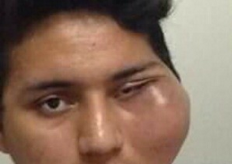 Após extrair dente, jovem fica com rosto deformado há quase 1 ano 