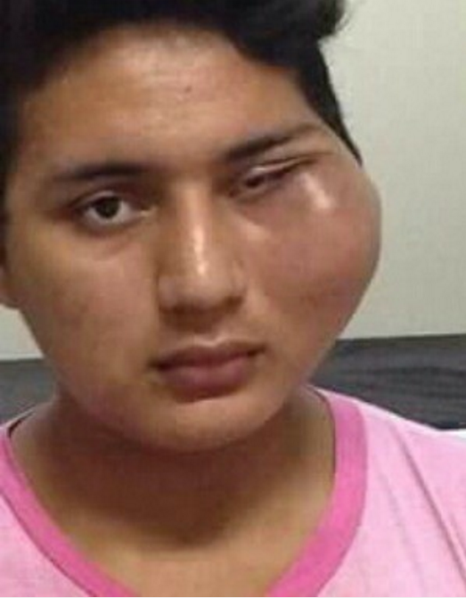 Após extrair dente, jovem fica com rosto deformado há quase 1 ano 