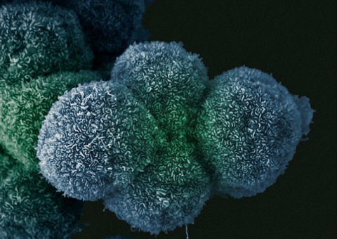 Estudo descobre proteína que espalha câncer pelo corpo; Ela gosta de gordura