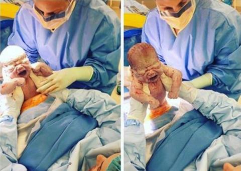 Mulher puxa o próprio bebê do útero durante cesariana 