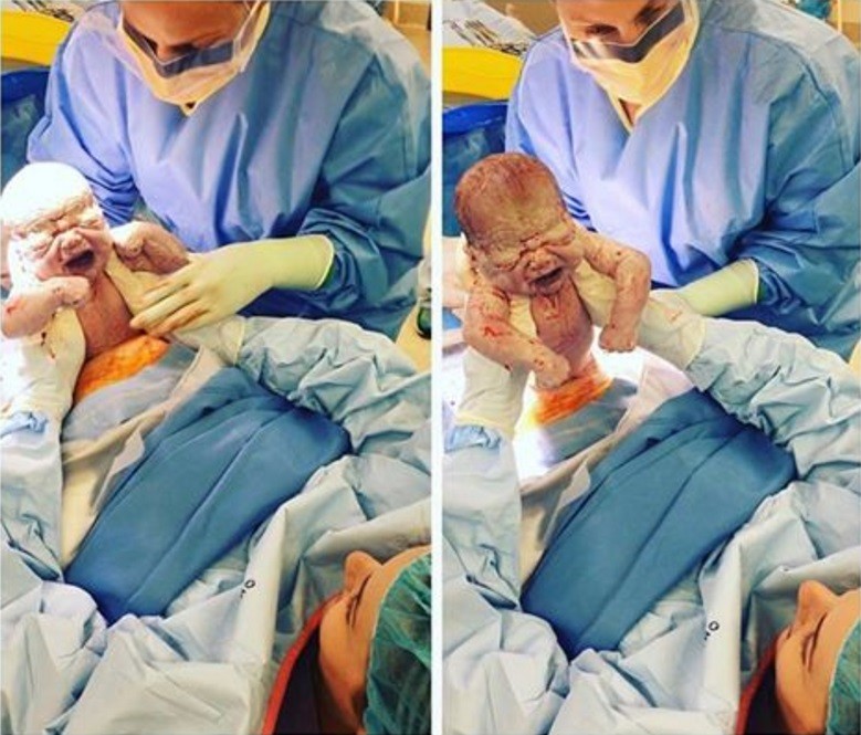 Mulher puxa o próprio bebê do útero durante cesariana 