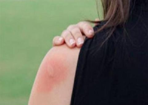 Saiba como se proteger das picadas de insetos de forma natural