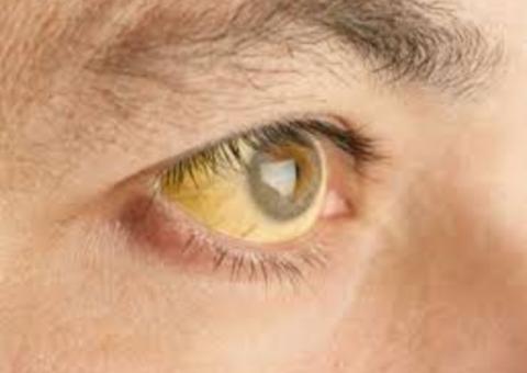 Manaus não registra febre amarela há 10 anos