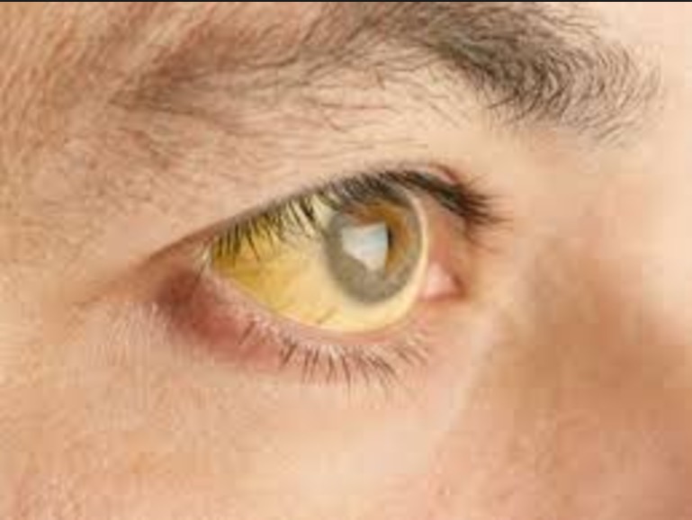 Manaus não registra febre amarela há 10 anos