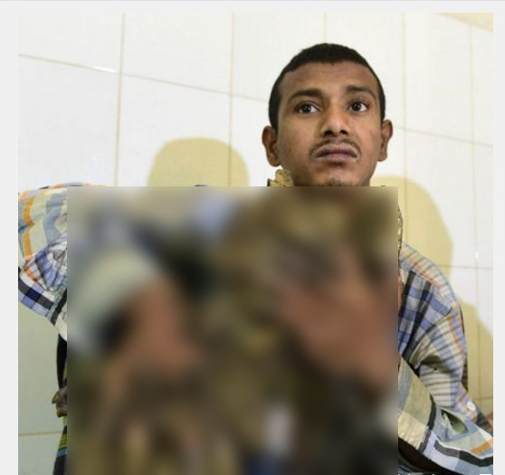 'Homem-árvore' faz 16 cirurgias após conviver com doença rara