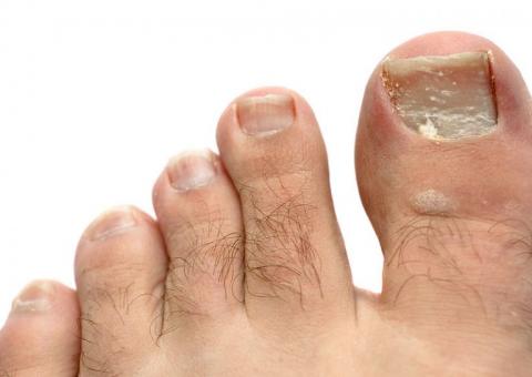 Conhecida como Folha da Fortuna, planta ajuda a combater frieiras